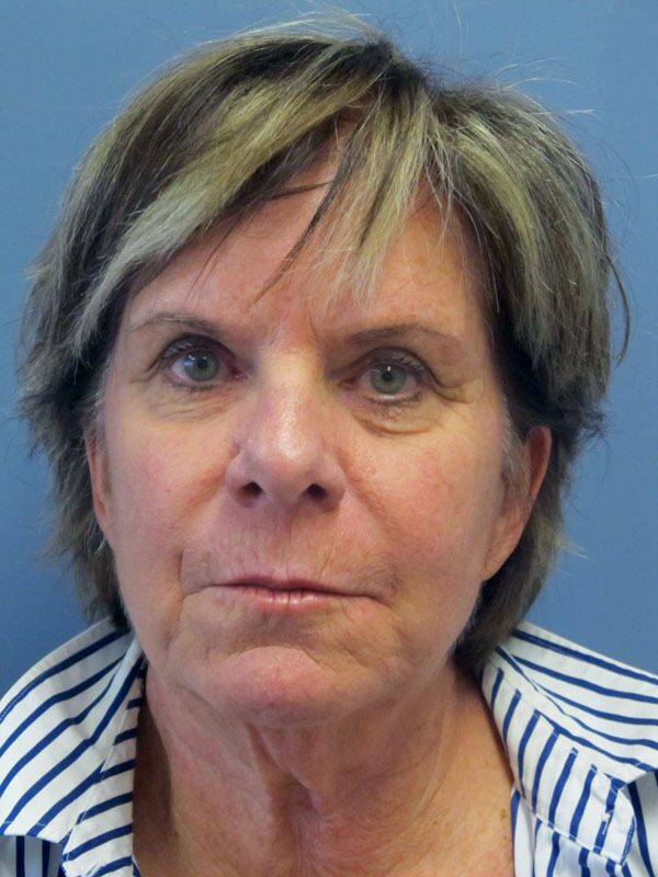 Before — SMAS Facelift/LiteLift/Mini Lift
