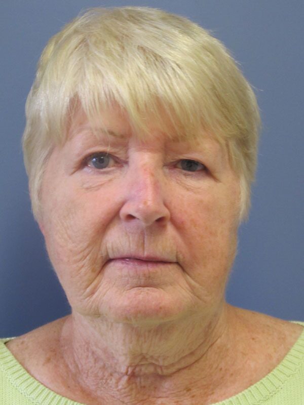 Before — SMAS Facelift/LiteLift/Mini Lift