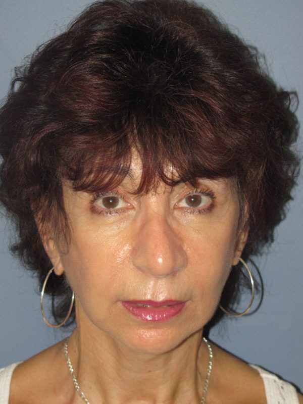 After — SMAS Facelift/LiteLift/Mini Lift