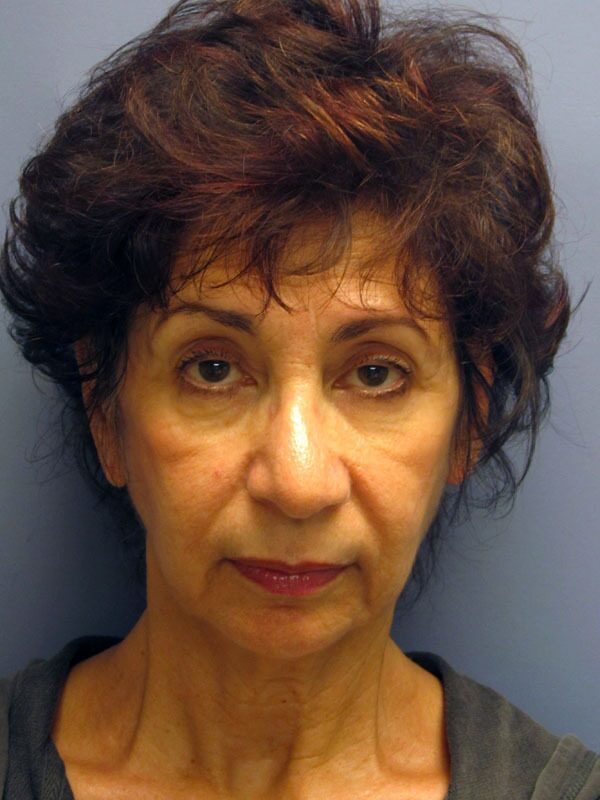 Before — SMAS Facelift/LiteLift/Mini Lift