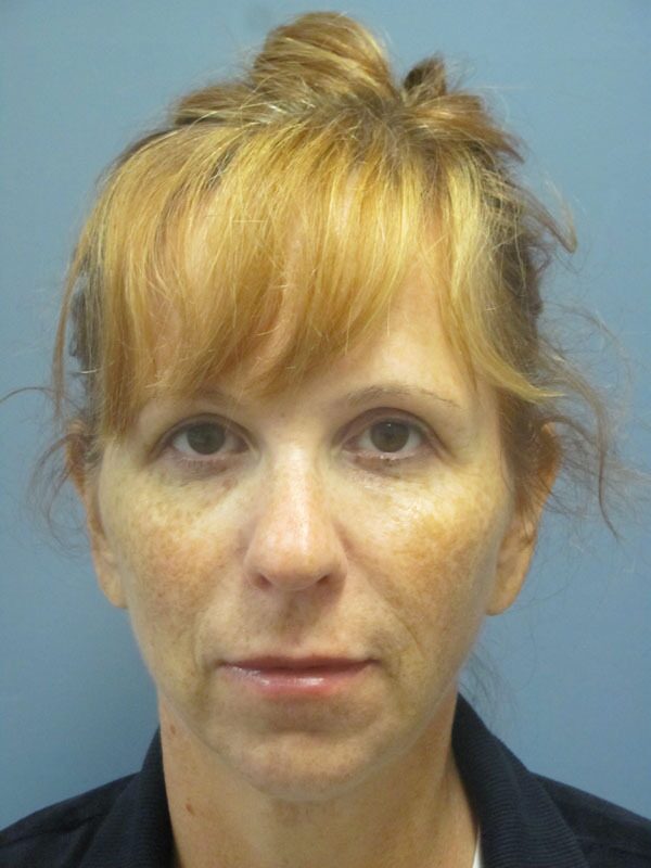 Before — SMAS Facelift/LiteLift/Mini Lift