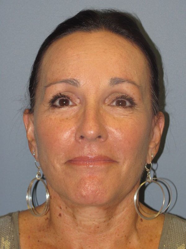 After — SMAS Facelift/LiteLift/Mini Lift