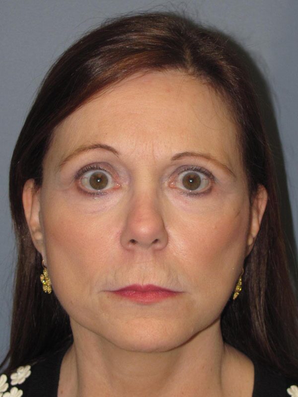 After — SMAS Facelift/LiteLift/Mini Lift 