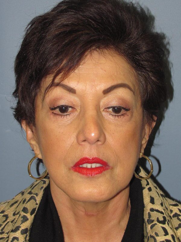 After — SMAS Facelift/LiteLift/Mini Lift 