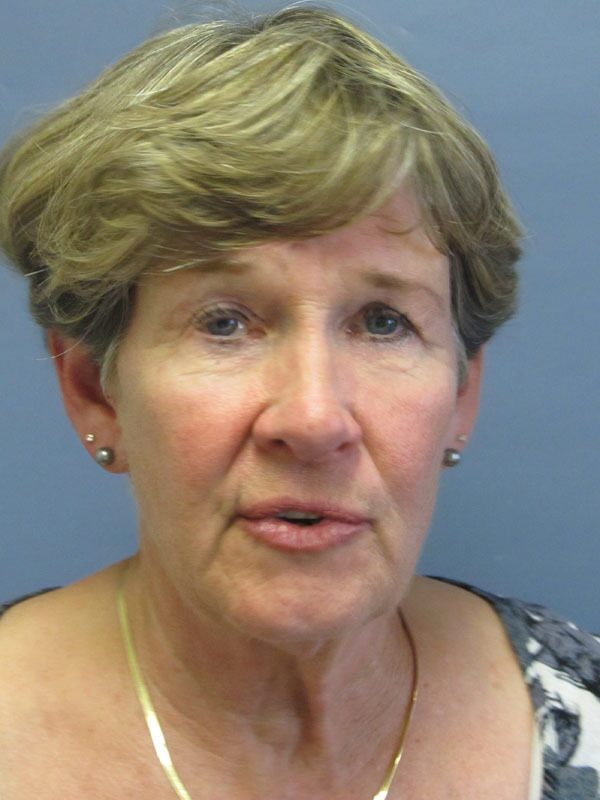 Before — SMAS Facelift/LiteLift/Mini Lift 