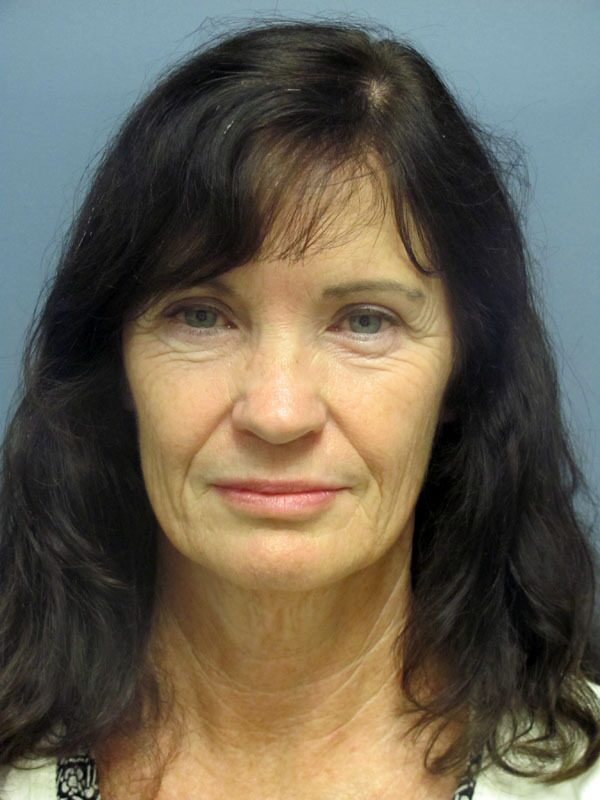 Before — SMAS Facelift/LiteLift/Mini Lift