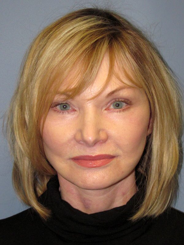 After — SMAS Facelift/LiteLift/Mini Lift