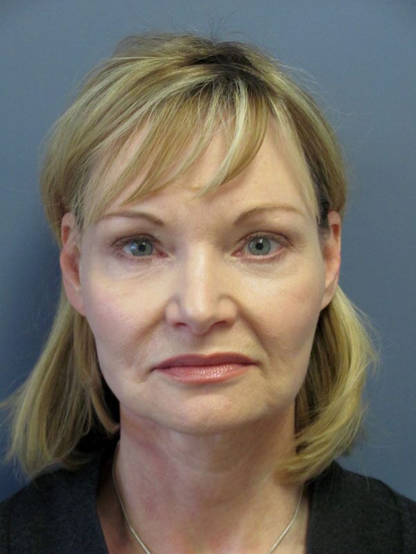 Before — SMAS Facelift/LiteLift/Mini Lift
