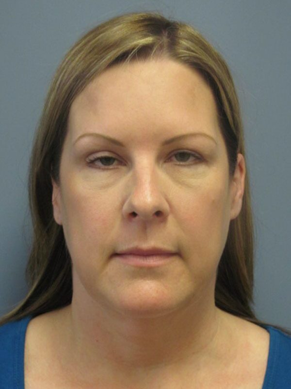 Before — SMAS Facelift/LiteLift/Mini Lift