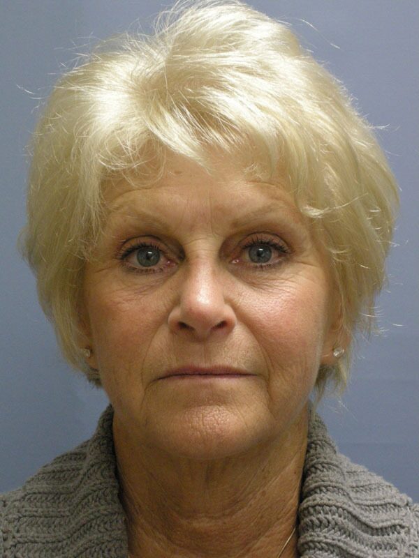 Before — SMAS Facelift/LiteLift/Mini Lift
