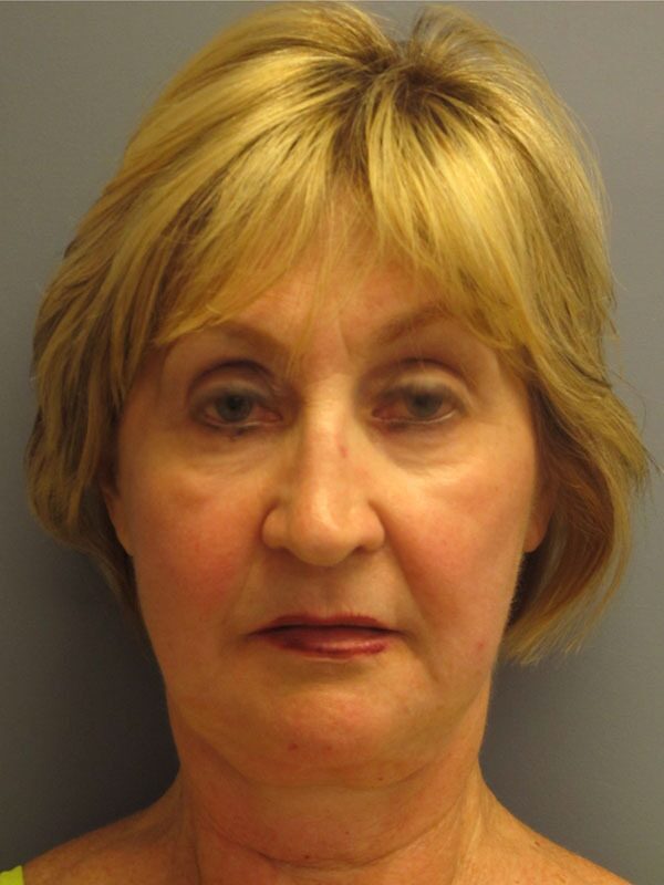 Before — SMAS Facelift/LiteLift/Mini Lift