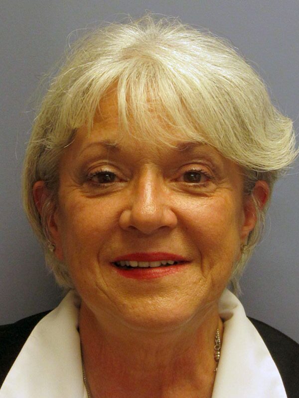 Before — SMAS Facelift/LiteLift/Mini Lift