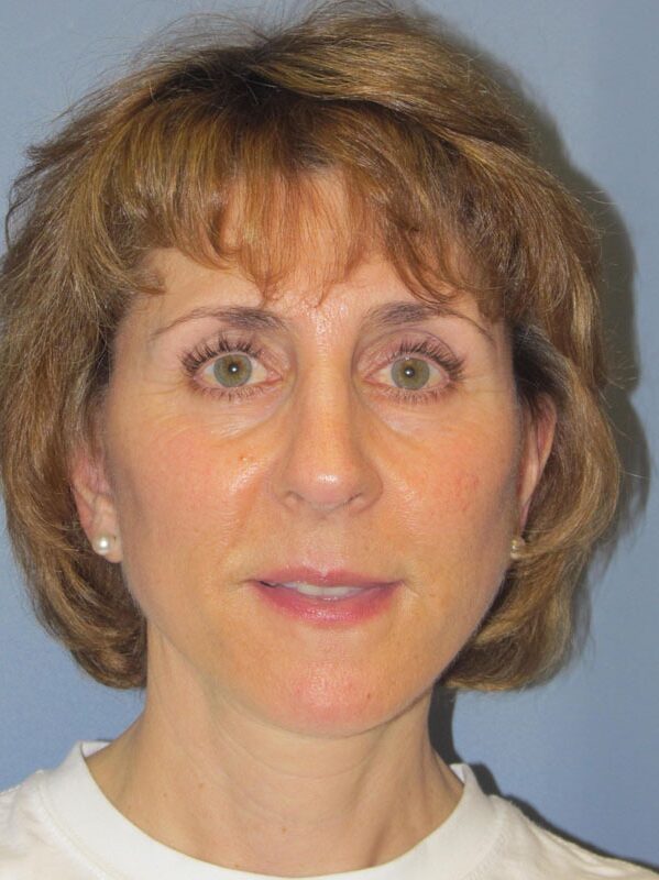 After — SMAS Facelift/LiteLift/Mini Lift