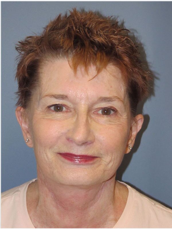 After — SMAS Facelift/LiteLift/Mini Lift