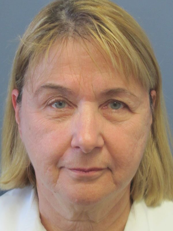 Before — SMAS Facelift/LiteLift/Mini Lift