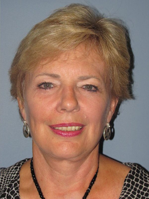 After — SMAS Facelift/LiteLift/Mini Lift 