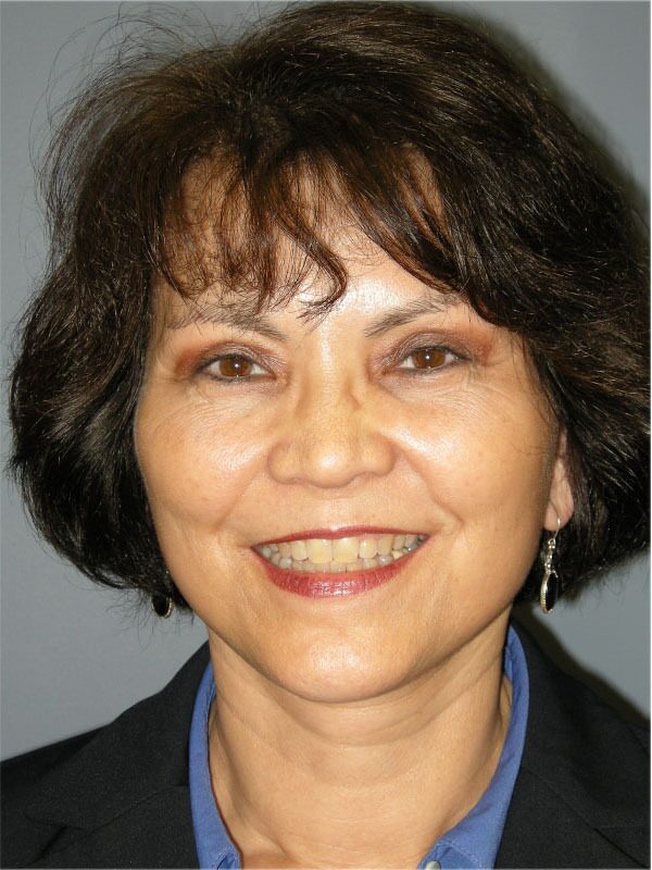 After — SMAS Facelift/LiteLift/Mini Lift 