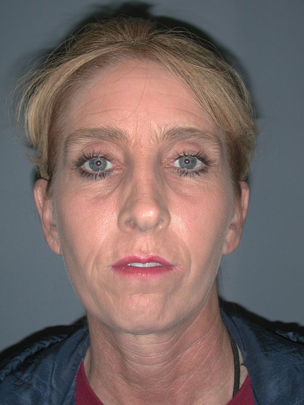 Before — SMAS Facelift/LiteLift/Mini Lift