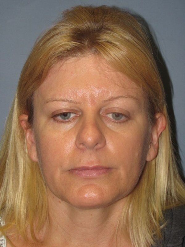Before — SMAS Facelift, LiteLift, Mini Lift
