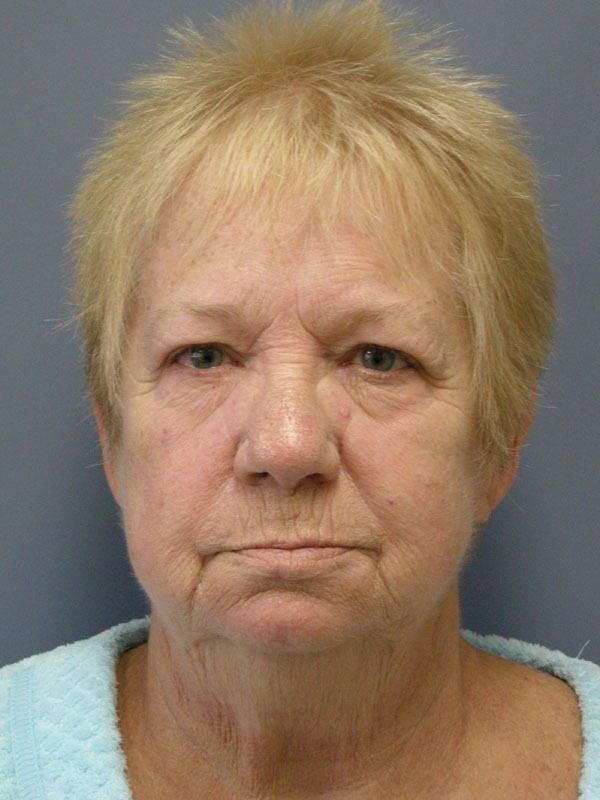 Before — SMAS Facelift/LiteLift/Mini Lift