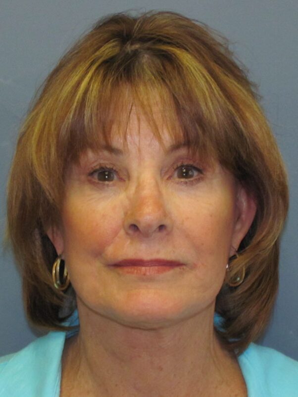 After — SMAS Facelift/LiteLift/Mini Lift