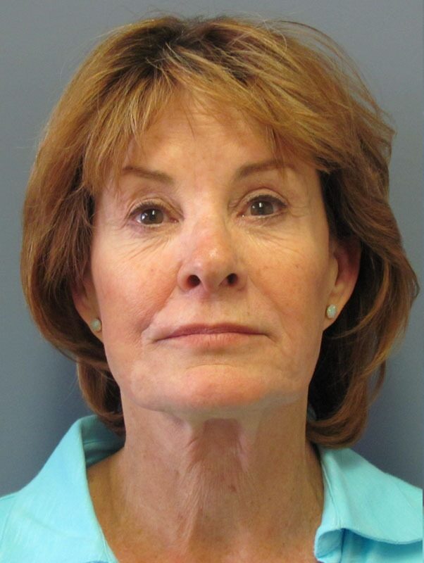 Before — SMAS Facelift/LiteLift/Mini Lift