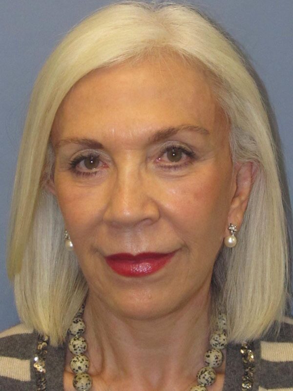 After — SMAS Facelift/LiteLift/Mini Lift