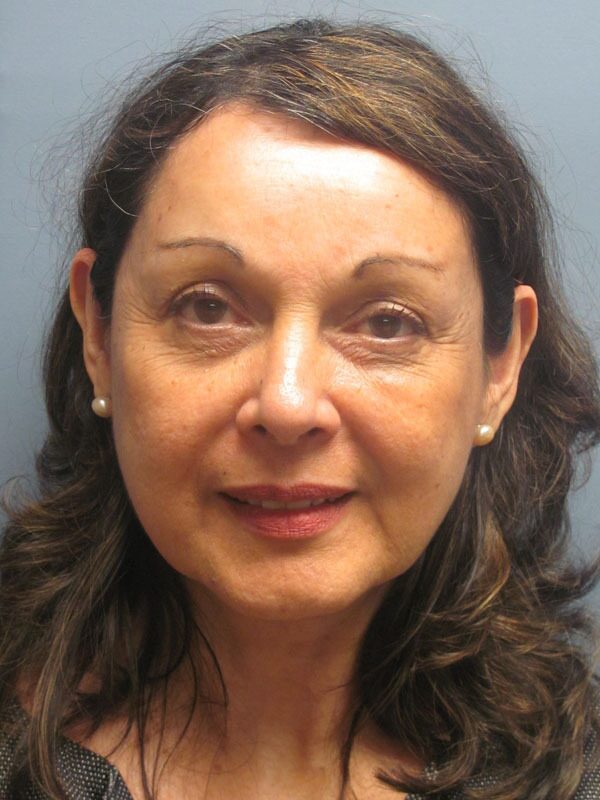 Before — SMAS Facelift/LiteLift/Mini Lift