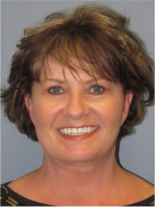 After — SMAS Facelift/LiteLift/Mini Lift
