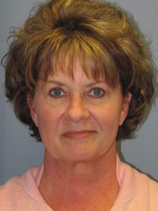 Before — SMAS Facelift/LiteLift/Mini Lift