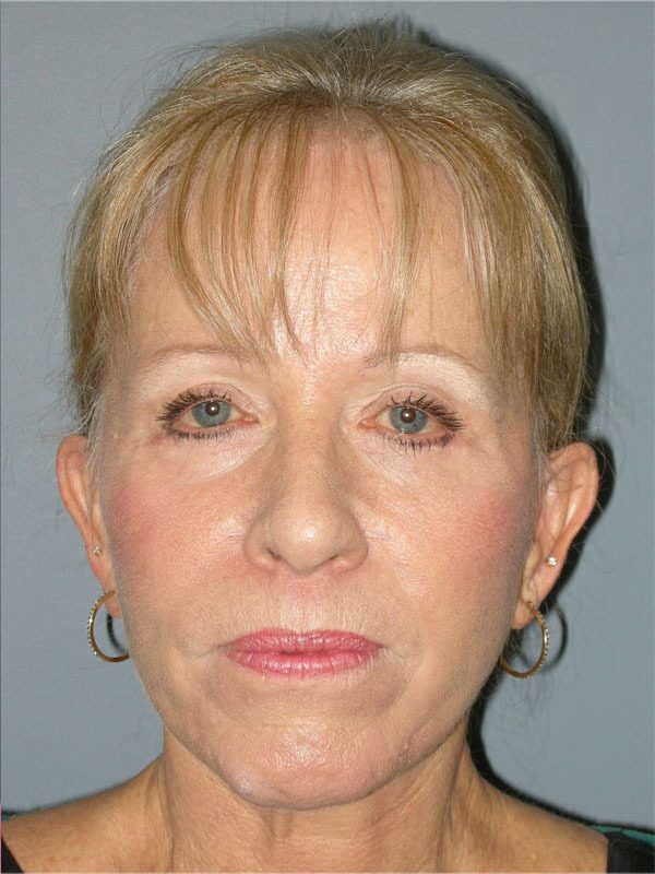 After — SMAS Facelift/LiteLift/Mini Lift