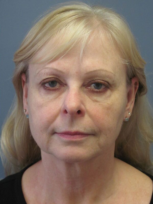 Before — SMAS Facelift/LiteLift/Mini Lift