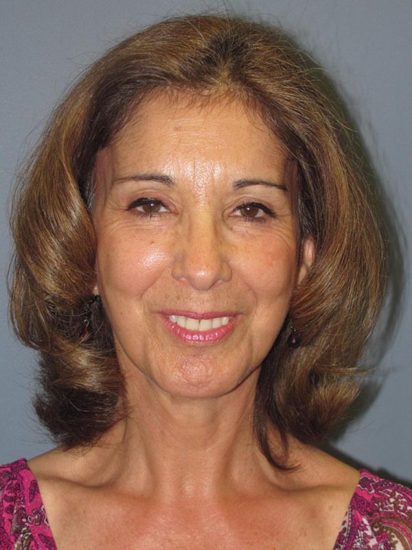 After — SMAS Facelift/LiteLift/Mini Lift