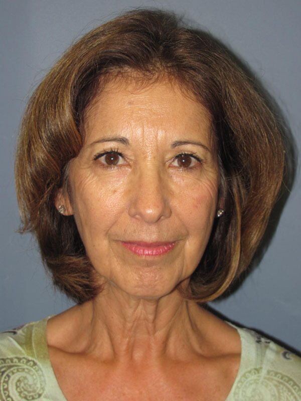 Before — SMAS Facelift/LiteLift/Mini Lift