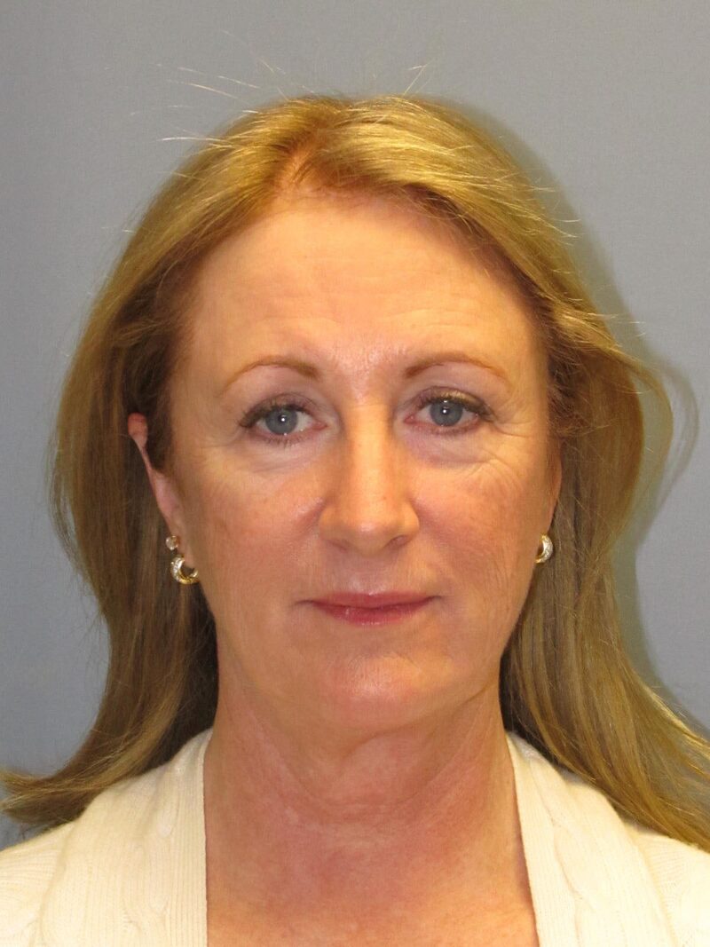 Before — SMAS Facelift/LiteLift/Mini Lift