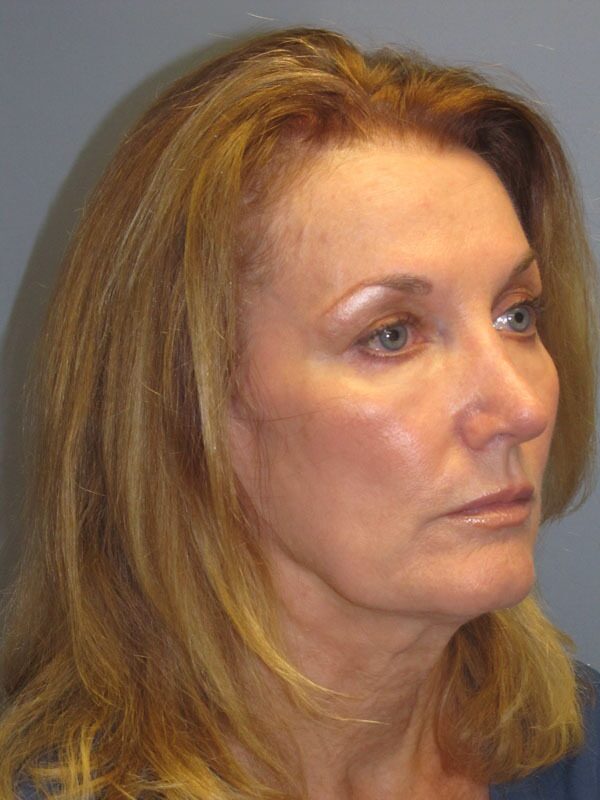 Before — SMAS Facelift/LiteLift/Mini Lift