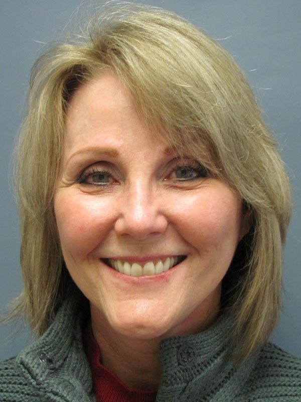 After — Chin Augmentation