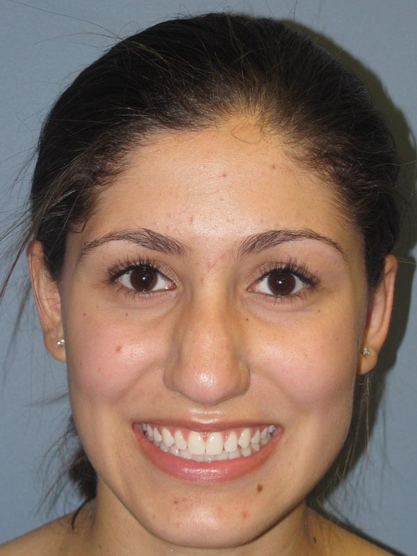After — Otoplasty, Ear Surgery