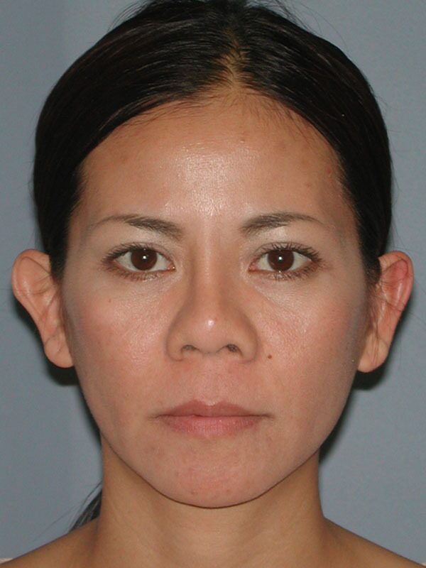Before — Otoplasty, Ear Surgery