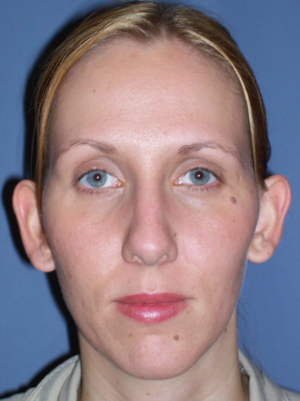 Before — Otoplasty, Ear Surgery