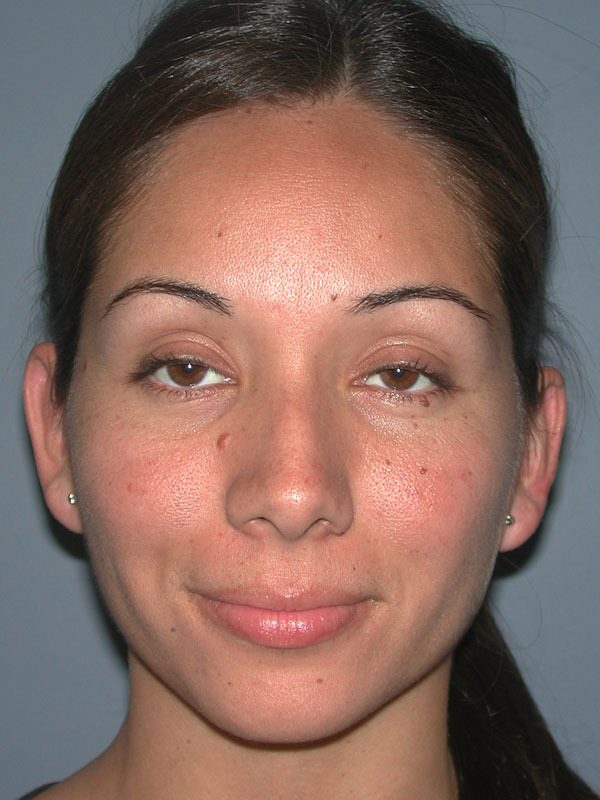 After — Otoplasty/Ear Surgery