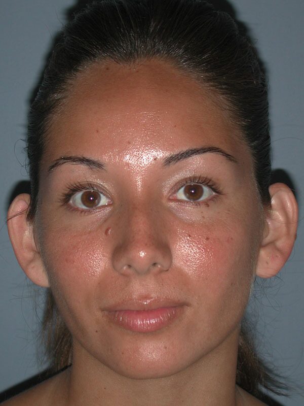 Before — Otoplasty/Ear Surgery