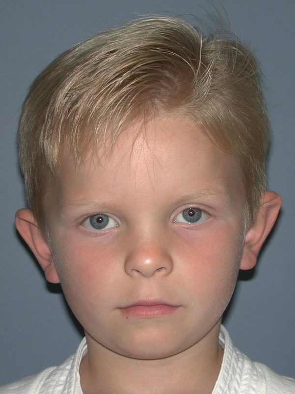 Before — Otoplasty/Ear Surgery