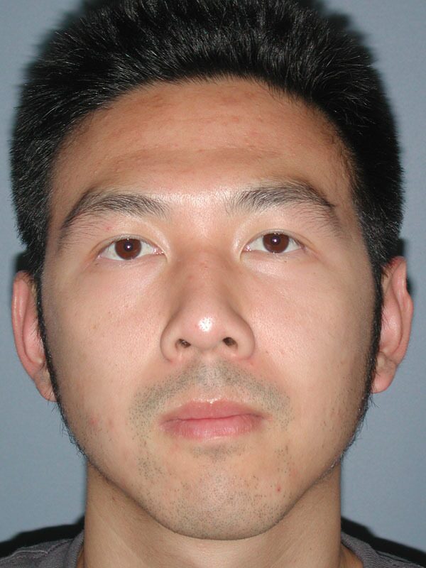 After — Otoplasty/Ear Surgery