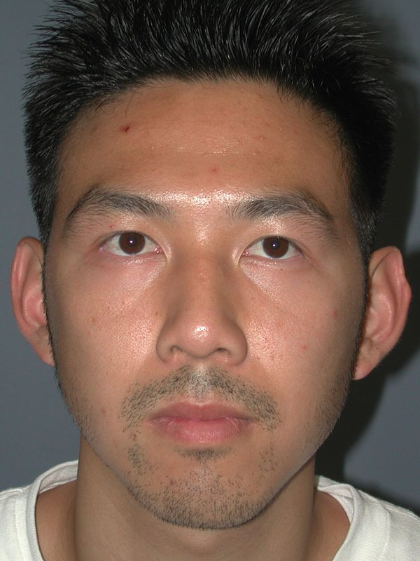 Before — Otoplasty/Ear Surgery