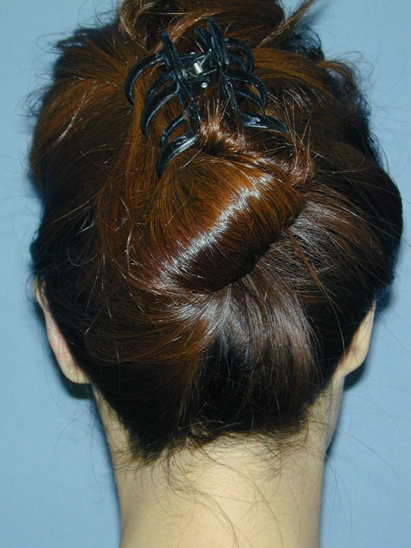 After — Otoplasty/Ear Surgery