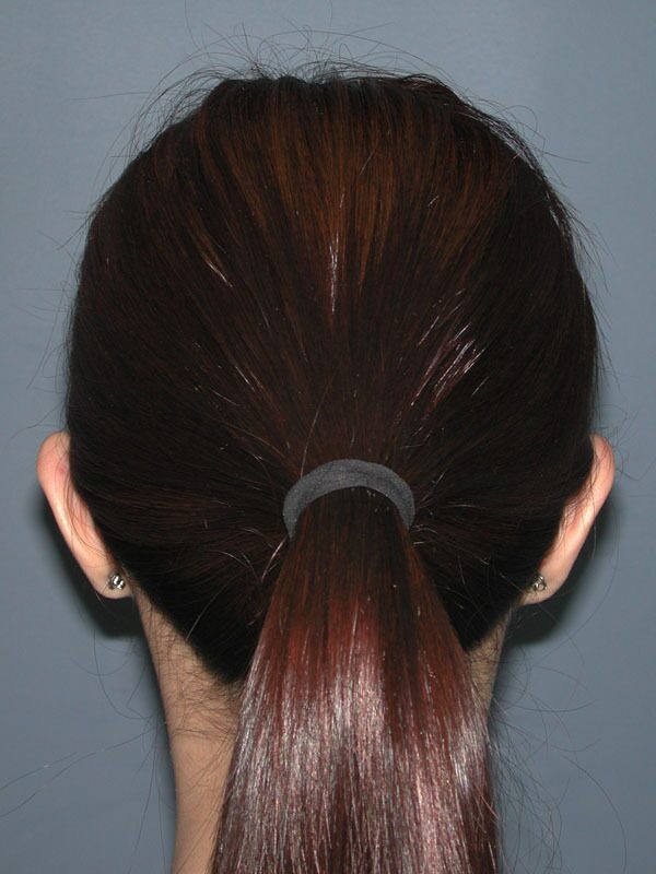 Before — Otoplasty/Ear Surgery