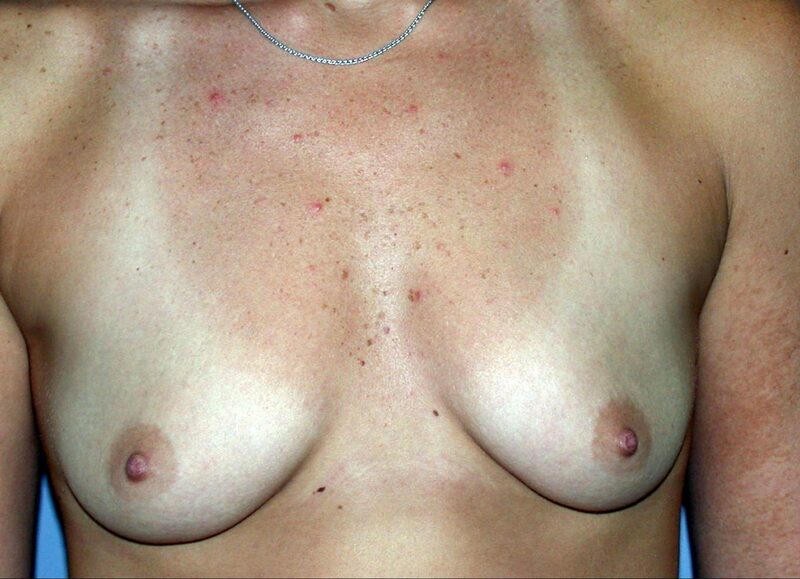 Before — Breast Augmentation]