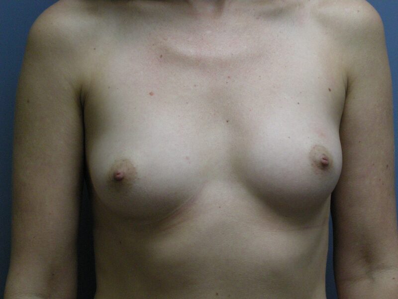 Before — Breast Augmentation