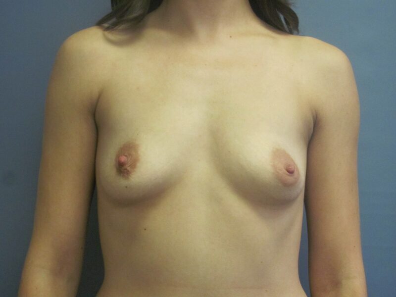 Before — Breast Augmentation